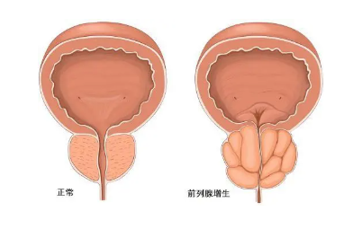 兩性健康 | 對(duì)于女性來(lái)說(shuō)，最怕男人得什么病？